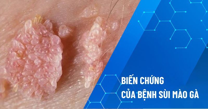 biến chứng của bệnh sùi mào gà