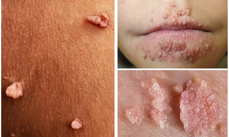 biểu hiện của các nốt sùi mào gà ở nữ