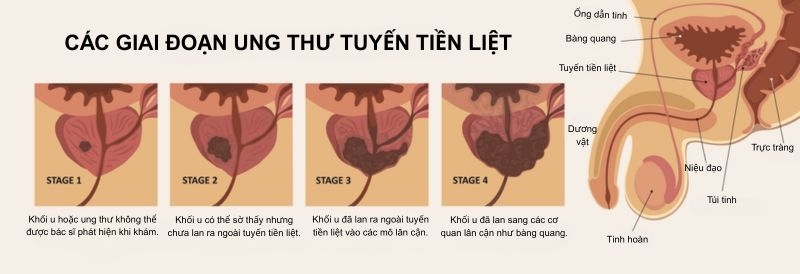 các giai đoạn ung thư tuyến tiền liệt (1)