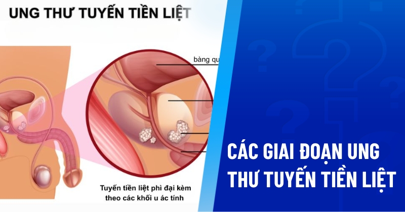 các giai đoạn ung thư tuyến tiền liệt (2)