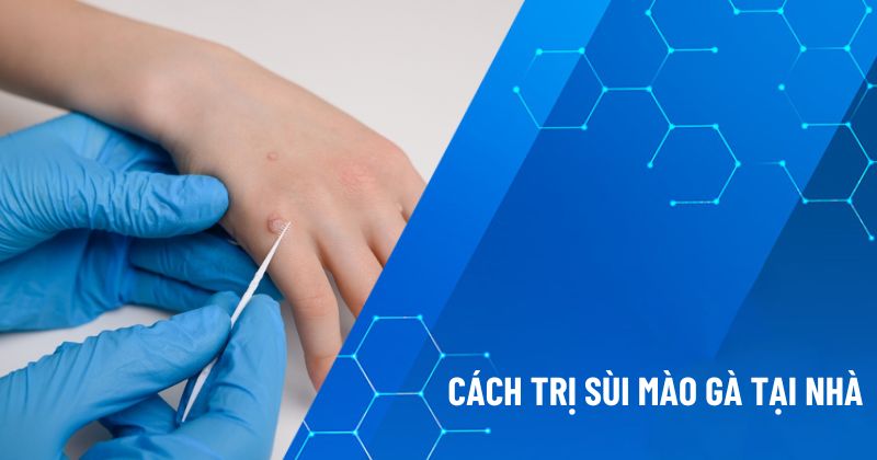 cách trị sùi mào gà