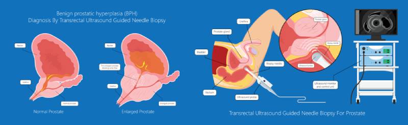 cắt bỏ tuyến tiền liệt