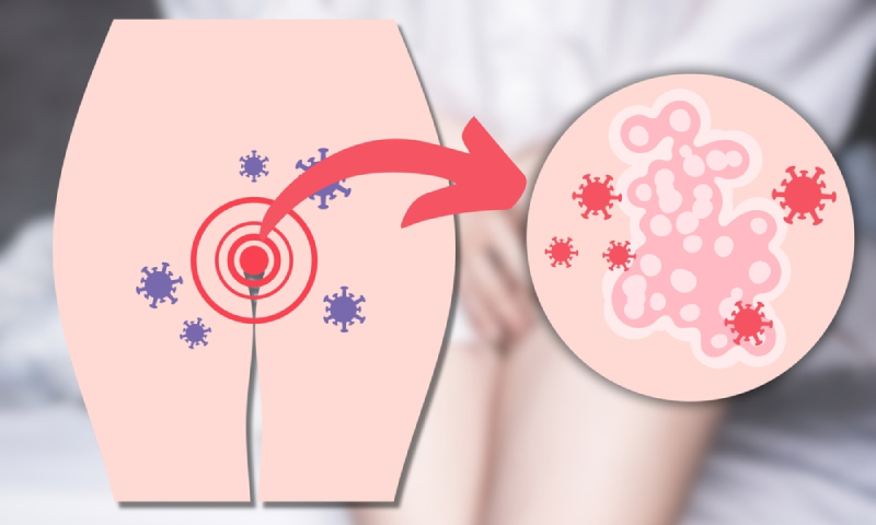 giữ vệ sinh sạch sẽ sau đốt sùi mào gà