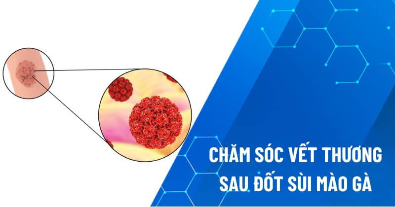 chăm sóc vết thương sau đốt sùi mào gà
