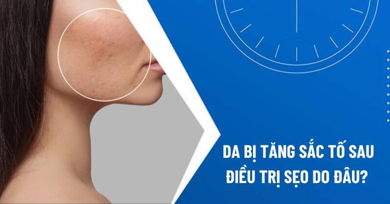 tăng sắc tố da sau điều trị sẹo