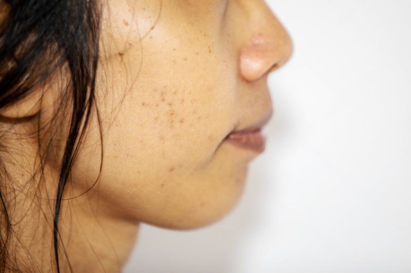 các đốm nâu xuất hiện tại vùng da điều trị laser