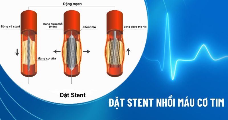 đặt stent nhồi máu cơ tim