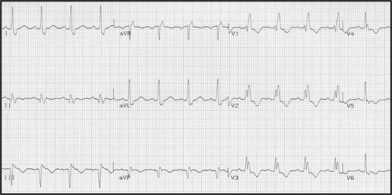 Điện tâm đồ nhồi máu cơ tim block nhánh phải