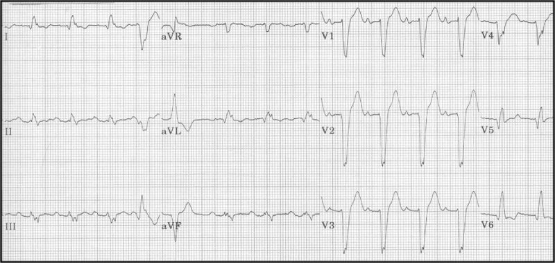 điện tâm đồ nhồi máu cơ tim block nhánh trái