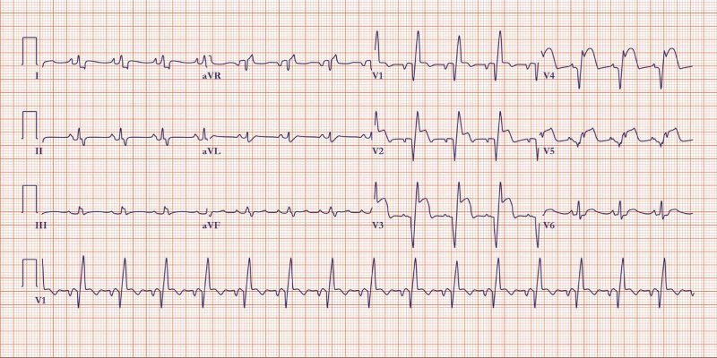 điện tâm đồ nhồi máu cơ tim đoạn ST chênh lên