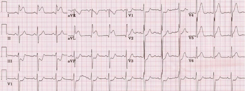 điện tâm đồ nhồi máu cơ tim st chênh lệch thành bên