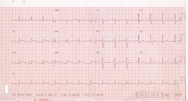 điện tâm đồ nhồi máu cơ tim st thành dưới
