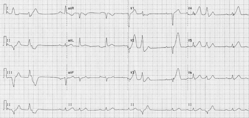 điện tâm đồ nhồi máu cơ tim thành trước cấp