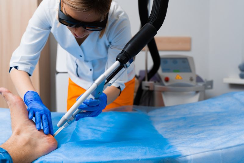 Điều trị sùi mào gà ở chân bằng laser phá hủy nốt sùi