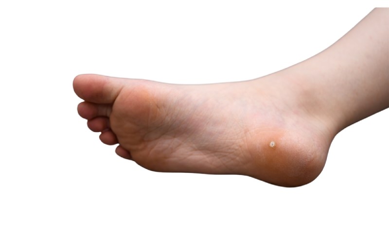 Điều trị sùi mào gà ở trẻ bằng theo dõi hoặc thuốc bôi