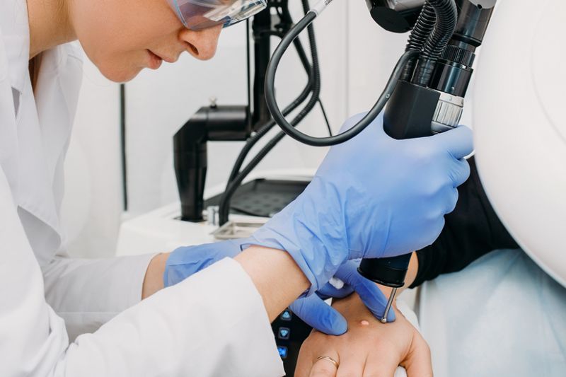 đốt điện loại bỏ sùi