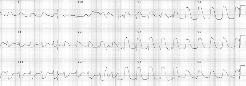 ecg nhồi máu cơ tim trước lan rộng với st hình bia mộ