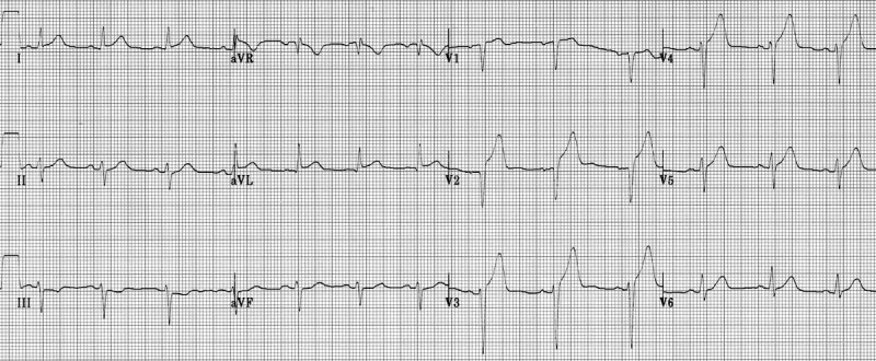ecg nhồi máu cơ tim trước vách st chênh lên v2-v4
