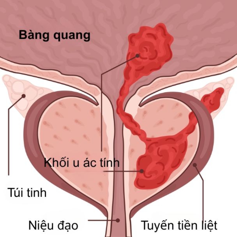 khối u tiền liệt tuyến ác tính