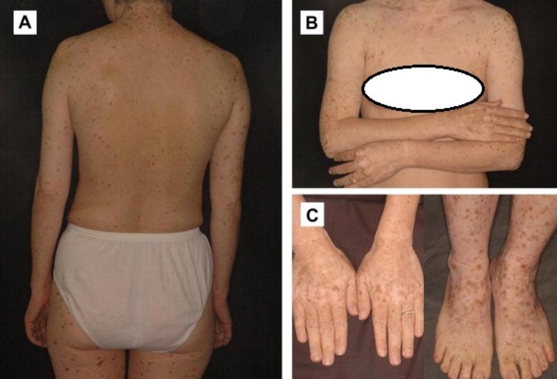 Mảng da tăng, giảm sắc tố đối xứng ở lưng, ngực, chi
