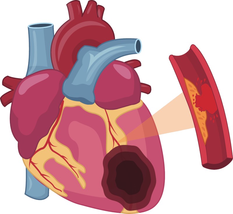 mảng xơ vữa gây nhồi máu cơ tim