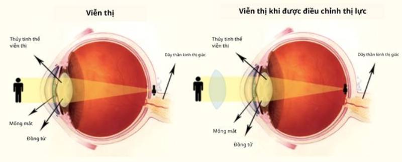 mắt viễn thị