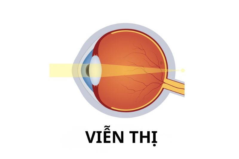 nhãn cầu ngắn hơn bình thường