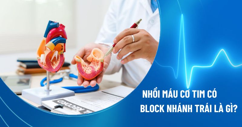 nhồi máu cơ tim có block nhánh trái