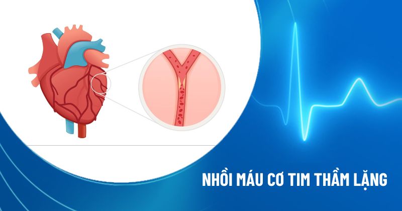 nhồi máu cơ tim thầm lặng