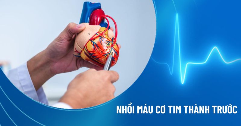 nhồi máu cơ tim thành trước