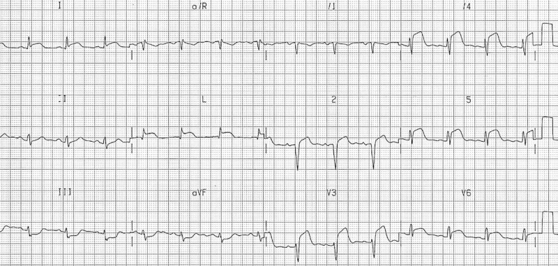 nhồi máu cơ tim trước bên lan rộng trên ecg