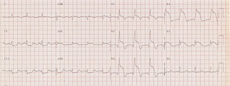 Nhồi máu cơ tim trước vách cấp tính với đoạn ST chênh lên tối đa ở V1-4
