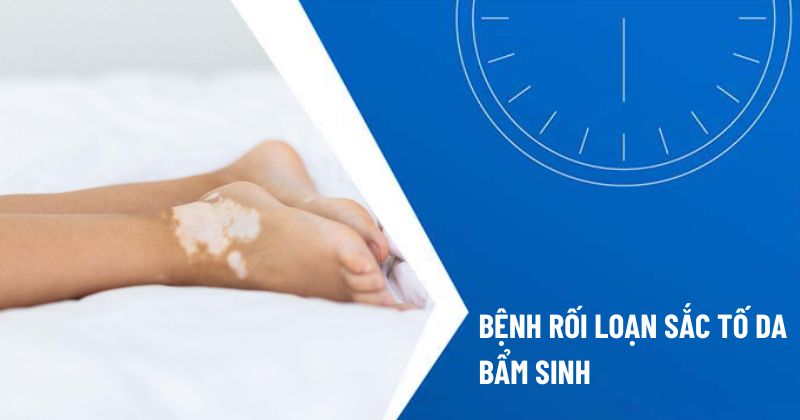 rối loạn sắc tố da bẩm sinh