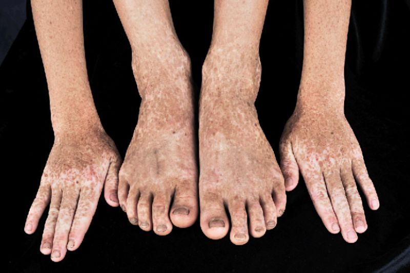 sắc tố đan xen dạng lưới