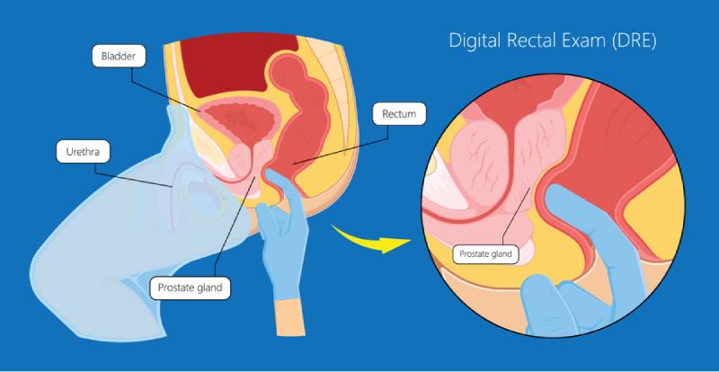 sờ nắn tuyến tiền liệt