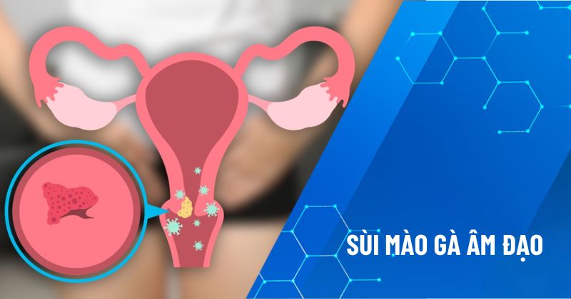 Tư vấn: Sùi mào gà âm đạo có gây đau đớn không?
