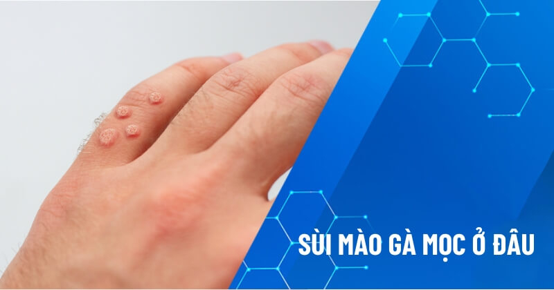 sùi mào gà mọc ở đâu