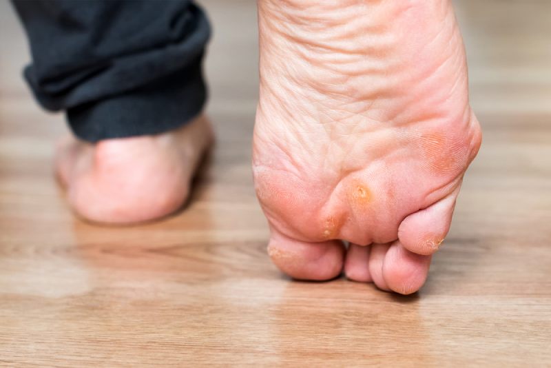 Sùi mào gà ở chân gây đau, khó đi lại, dễ nhiễm trùng