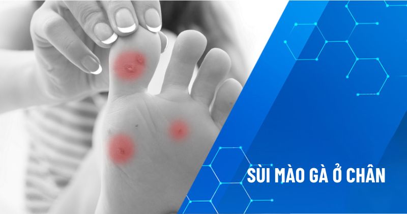 Mọc sùi mào gà ở chân và giải pháp điều trị an toàn