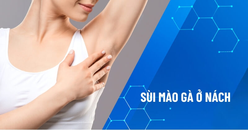 sùi mào gà ở nách