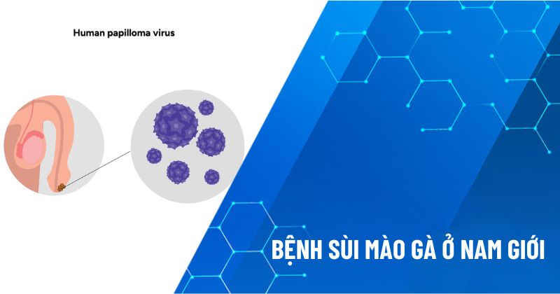 sùi mào gà ở nam