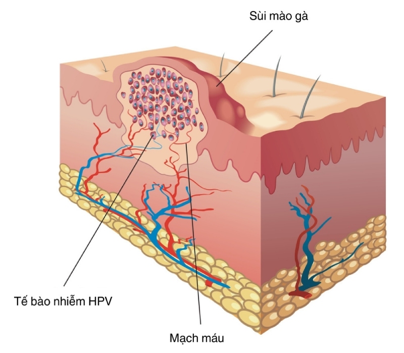 sùi mào gà ở nữ do virus hpv gây ra