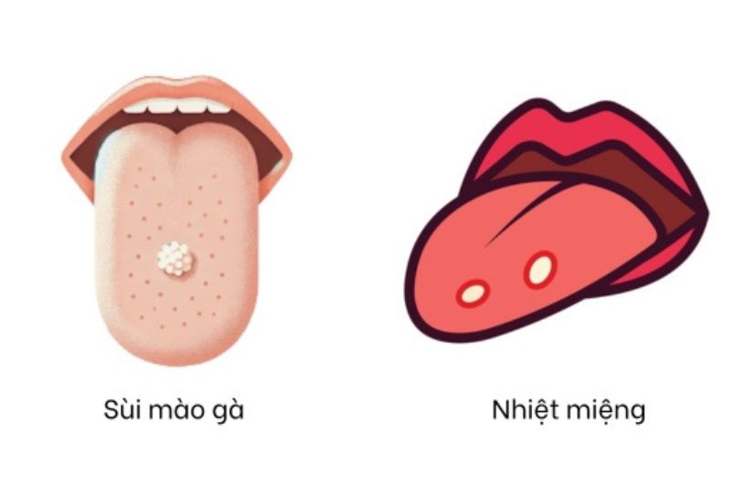 sùi mào gà và nhiệt miệng khác nhau