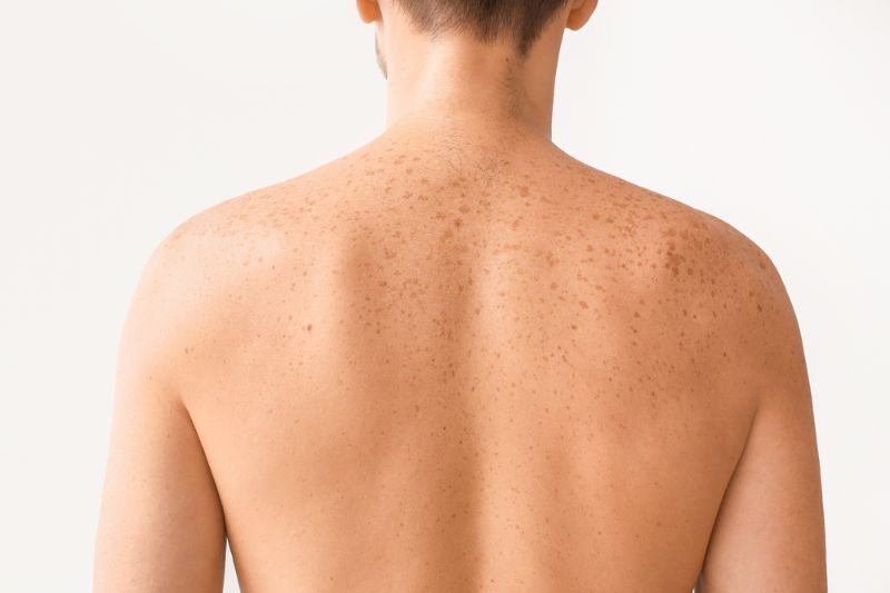 tàn nhang ở lưng