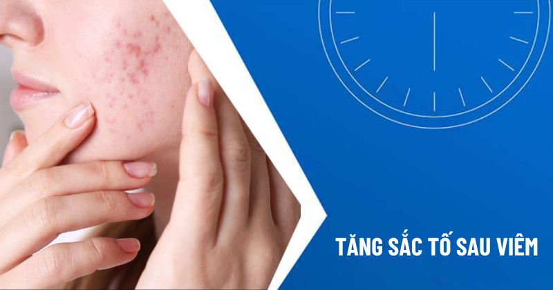 tăng sắc tố sau viêm