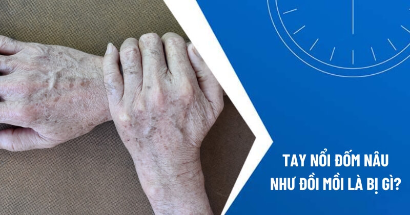 tay nổi đốm nâu như đồi mồi là bị gì