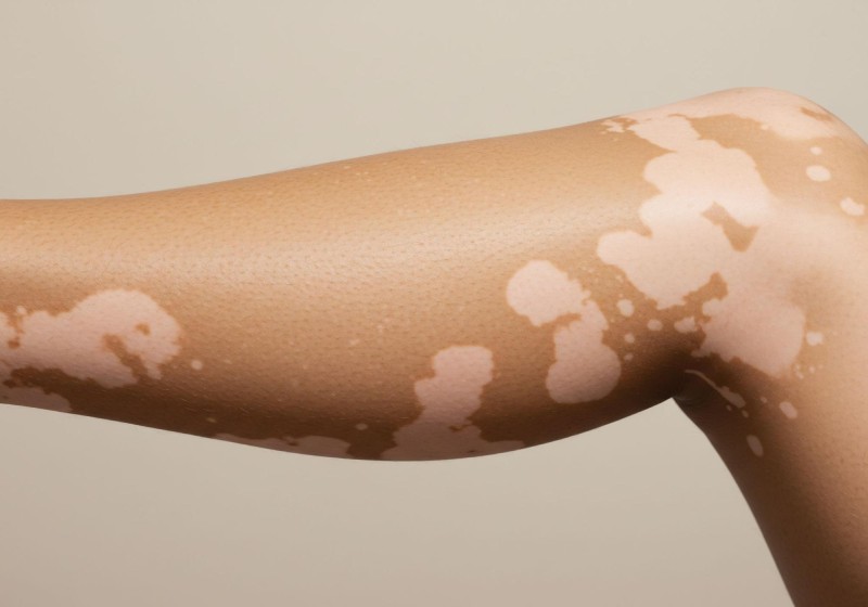 thiếu sắc tố da dễ nhận biết qua quan sát bằng mắt thường