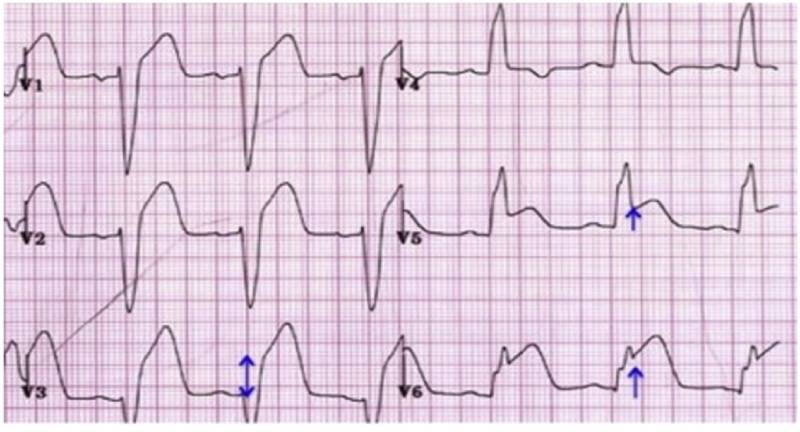 tiêu chuẩn sgarbossa