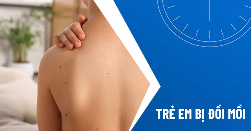 trẻ em bị đồi mồi