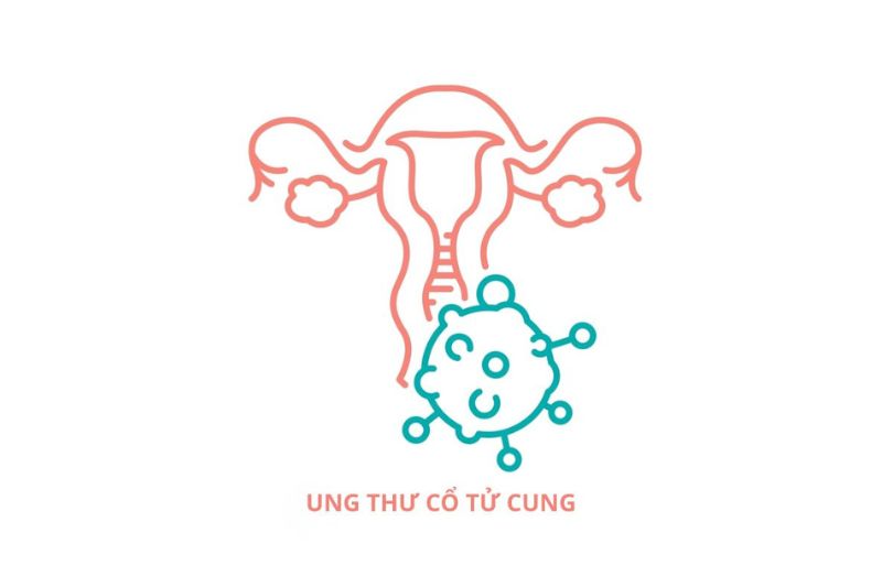 ung thư cổ tử cung